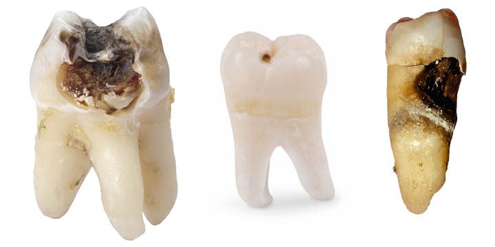 dental caries