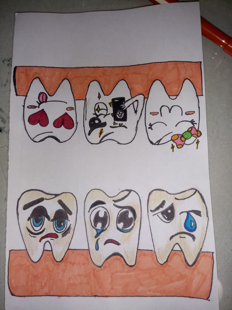 Fluorosis dental
